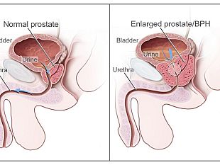 tumore-prostata-in-toscana-aumentano-casi-diminuisce-mortalita