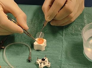 livorno-eseguito-per-la-prima-volta-il-trapianto-di-un-solo-strato-del