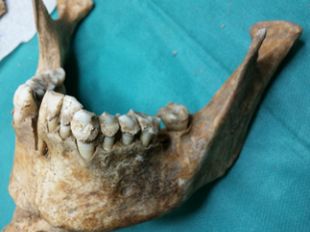 virus-umano-sconosciuto-legato-ai-tumori-mammari-individuato-in-antichi-resti-umani
