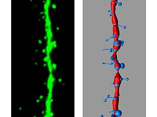 nuova-forma-di-autismo-individuata-a-pisa
