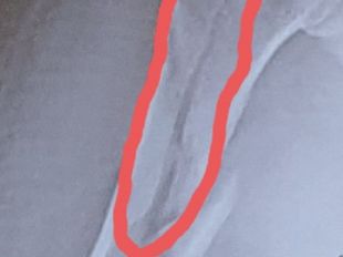 ospedali-a-prato-il-tutore-a-firenze-un-intervento-chirurgico