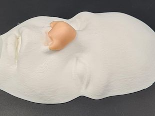 bambino-nato-senza-naso-ricostruzione-perfetta-al-meyer