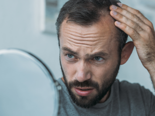 caduta-dei-capelli-maschile-scopriamo-i-rimedi-piu-diffusi