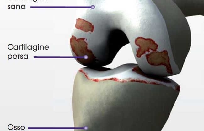 b304021443-ginocchio-ed-artrosi-i-migliori-chirurghi-d-europa-si-ritrovano-a-firenze