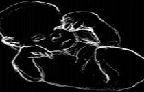 a406041749-nata-con-una-rarissima-malformazione-la-fusione-degli-arti-inferiori-br-e-all-ospedale-meyer-di-firenze