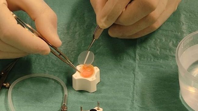 Oculistica: a Livorno tecnica avanzata di trapianto corneale