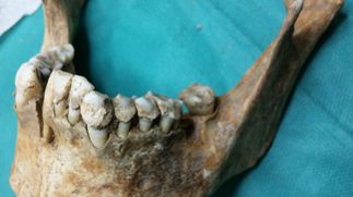 Virus umano sconosciuto legato ai tumori mammari individuato in antichi resti