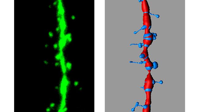 Nuova forma di autismo individuata in Toscana