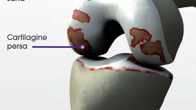 Chirurgia del ginocchio: chiuso il convegno a Firenze, ecco i risultati