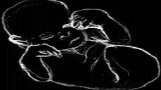 Nata con una rarissima malformazione: la fusione degli arti inferiori<BR>E' all'ospedale Meyer di Firenze