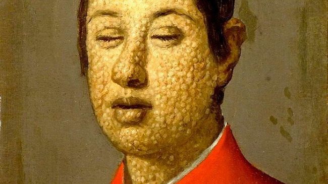 ​Vaccino sì, vaccino no? La lotta dei Granduchi di Toscana contro il vaiolo