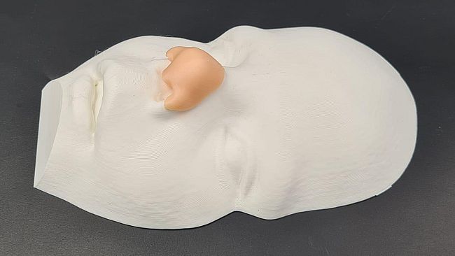 Bambino nato senza naso, ricostruzione perfetta al Meyer