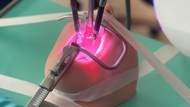 Robot chirurgico toglie cisti a una ragazza