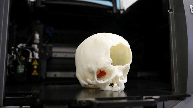 Al Meyer eseguito intervento innovativo e non invasivo grazie alla stampa 3D