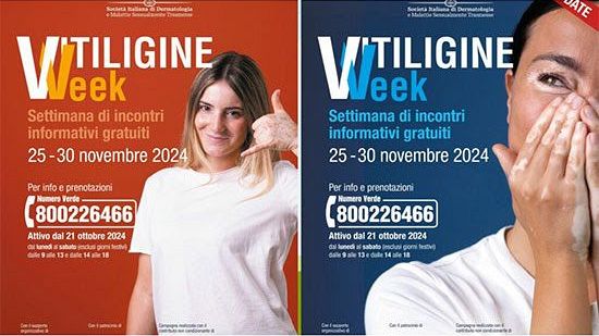 La 'Vitiligine Week' in Toscana: incontri gratuiti con i dermatologi